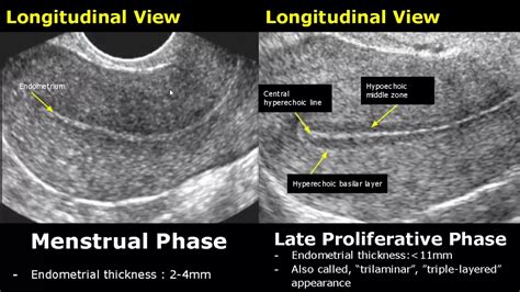 normal endometrial thickness ultrasound